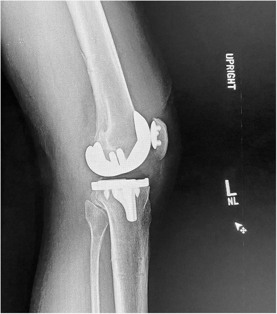 left lateral knee xray
